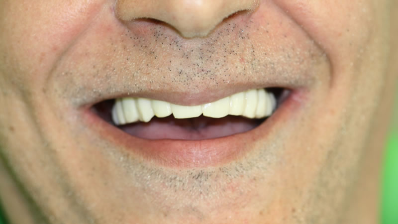 Prótesis Implantes