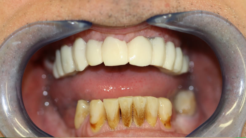 Prótesis Implantes
