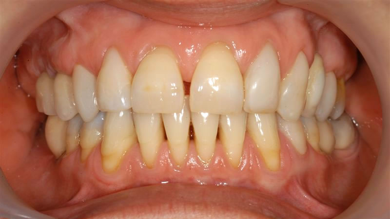 Implantes