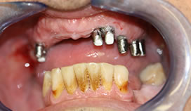 PRÓTESIS SOBRE IMPLANTES (Cementada)