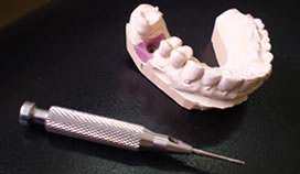 PRÓTESIS SOBRE IMPLANTES (ATORNILLADA)